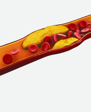 Wizualizacja cholesterolu odłożonego w żyłacyh | Lipiforma